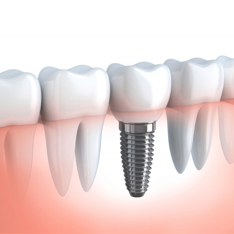 dental-implantlar