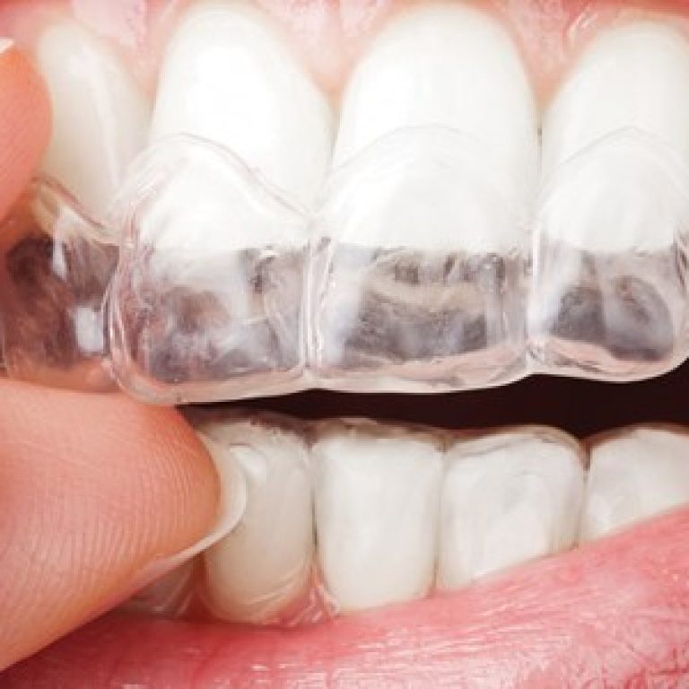 yetiskinlerde-ortodonti-tedavisi